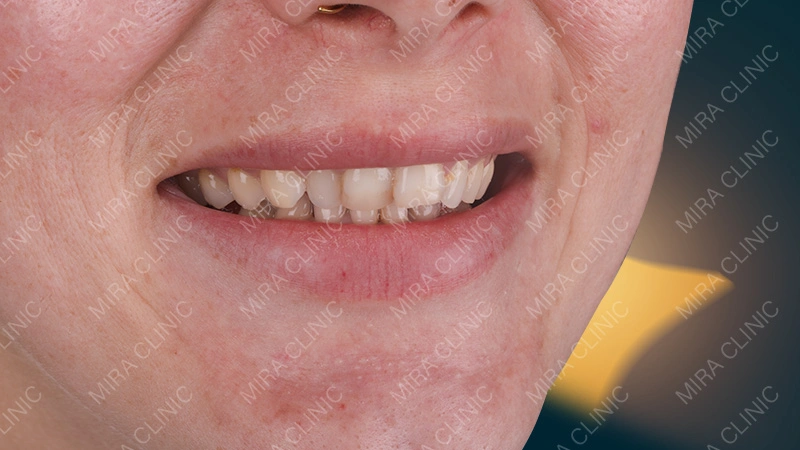 Hollywood smile patient story 